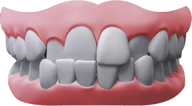 Crossbite2