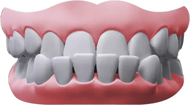 Underbite2